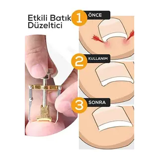 Batık Tırnak Çıkartıcı Orijinal Çelik Batan Tırnağı Düzeltme Aparatı Düzeltici Aleti Çıkarıcı Aparat